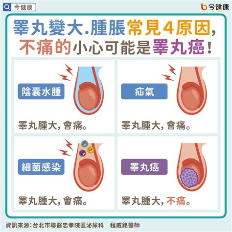 蛋蛋長肉芽|睪丸癌症狀、原因、存活率、檢查、治療、手術費用一。